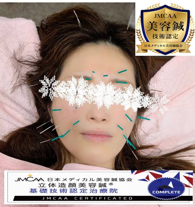 【美容鍼ってどんな効果があるの?】初めての方へ|お顔のお悩みにアプローチ!